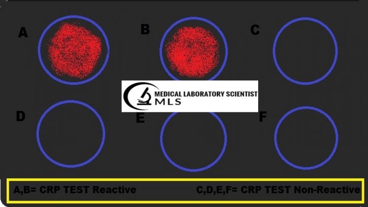 C-Reactive Protein Test: Principle, Procedure, Requirements, Results ...