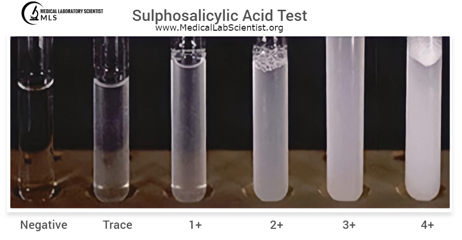 Sulphosalicylic Acid Test Results