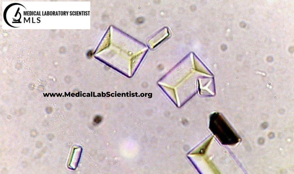 Triple Phosphate Crystals (Struvite Crystals)