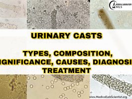 URINARY CASTS: Types, Composition, Significance, Causes, Diagnosis, Treatment