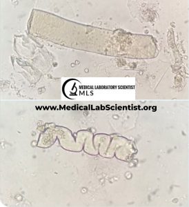 URINARY CASTS: Types, Composition, Significance, Causes, Diagnosis ...